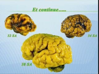 anatomie du cerveau au 1 er trim