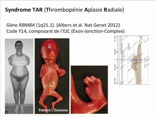 Thalidomide et trouble de l'angiogenèse : un modèle pour les anomalies des membres