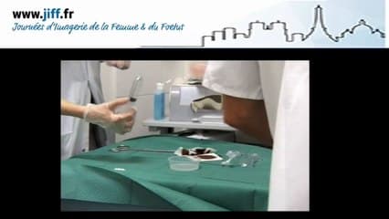 Place de l’hystérosonographie dans l’exploration de la cavité utérine de la femme infertile