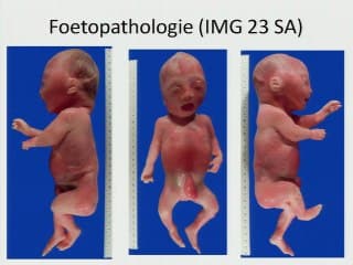 Syndrome de Conradi-Hunerman : à propos d'une observation anténatale