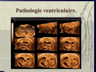 L'étude du cerveau foetal (3D)