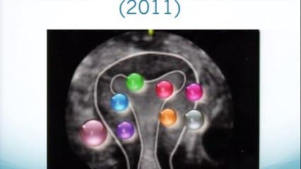 Fibromes : nouvelles stratégies Fibromes et grossesse : que doit-on surveiller ?