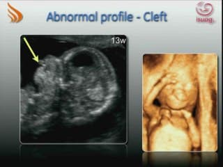 Dépistage d'anomalies morphologiques au 1er trimestre : De la théorie à la pratique, quel dépistage et pour qui ?