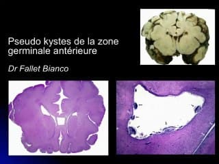 Les kystes autour des ventricules.
