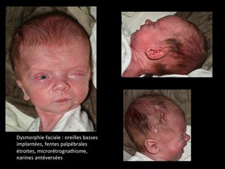 Une vitesse systolique de l'artère cérébrale moyenne élevée n'est pas toujours synonyme d'anémie foetale : à propos d'une observation en anténatal