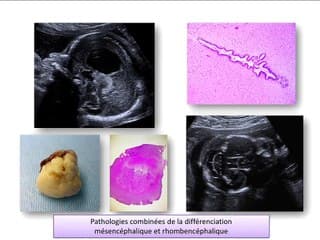 Le Cavum du Septum Pellucidum ; un point d’appel incontournable des pathologies cérébrales