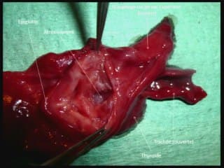 Insuffisances, incertitudes, difficultés, piéges et erreurs de l'imagerie anténatale : Le thorax.