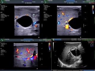 Quand peut-on suspecter une atrésie des voies biliaires en prénatal?