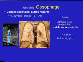 Aspects échographiques normaux de l'appareil digestif foetal
