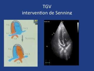 Et si on vous montrait la suite ? Transposition des gros vaisseaux