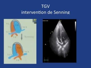 Et si on vous montrait la suite ? Transposition des gros vaisseaux