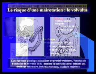 Malrotation et volvulus : du nouveau-né au foetus.