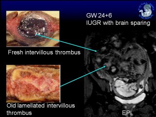 IRM du placenta  ( en ANGLAIS )