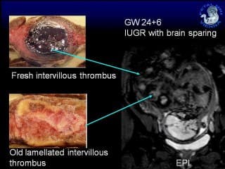 IRM du placenta  ( en ANGLAIS )