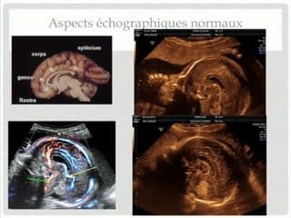 SYSTÈME NERVEUX CENTRAL Ligne médiane et corps calleux