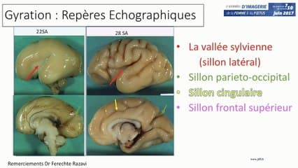 Evaluation de la maturation cérébrale : giration, migration et apports des nouvelles techniques IRM