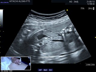 Live: Appareil digestif : quelques piéges échographiques :