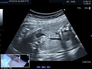 Live: Appareil digestif : quelques piéges échographiques :