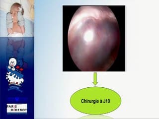 Facteurs échographiques anténataux prédictifs de chirurgie néonatale précoce dans les malformations pulmonaires