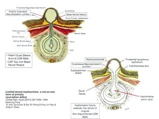 Limited Dorsal Myeloschisis
