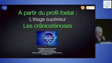 A partir de la coupe du profil : les craniosténoses