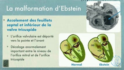 Coeur foetal II : c’est trop gros ! Malformation d’Ebstein et autres dysplasies tricuspides