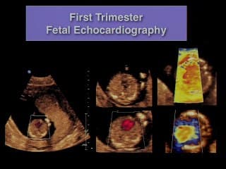 échographie 3D  matricielle ( en ANGLAIS )