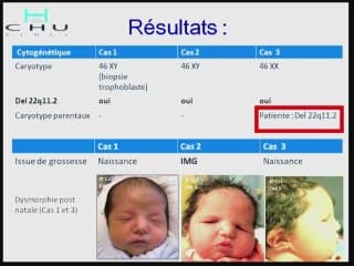 hydramnios et agénésie thymique avec microdéletion 22q11