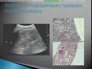 de la pyélectasie au rein hyperéchogene
