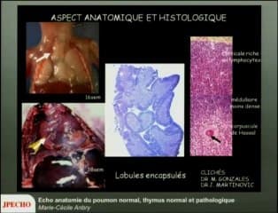 Echo anatomie du poumon normal, thymus normal et pathologique
