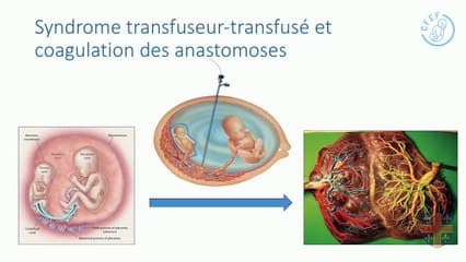 49 Évolution peri-opératoire des dopplers dans le syndrome transfuseur-transfusé