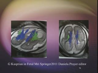 Et si on vous montrait la suite ? Agénésie du corps calleux