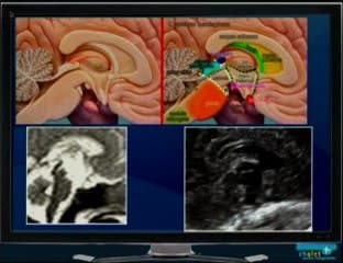 Anomalie plancher V3
