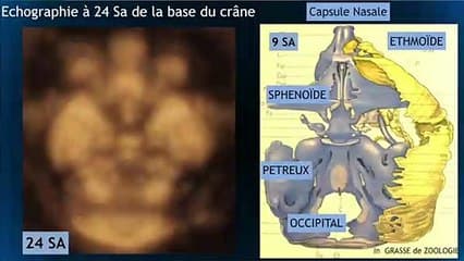 L’éthmoïde du fœtus : développement, imagerie échographique, application en dysmorphologie