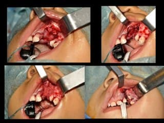 Fentes labio-palatines et vélo-palatines, rétrognatisme › Prise en charge périnatale et possibilités de réparation en fonction du type