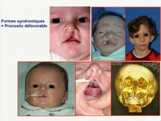 Fente labio-palatine isolée : Prise en charge chirurgicale