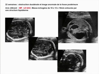 thrombose sinus transverse gauche