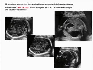 thrombose sinus transverse gauche