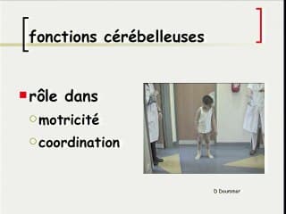 5 Pathologies du cerveau foetal fosse post