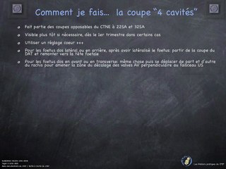 POSTER Coupe 4 cavités