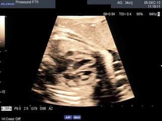 Une image inhabituelle de l'oreillette droite.