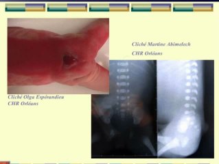 Spina bifida