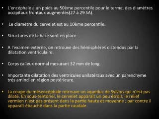 Rhombencéphalosynapsis