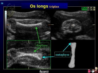 L'apport du 3D dans la pathologie osseuse