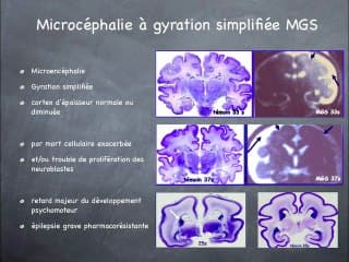 Petits crânes : microcéphalies, CMV?