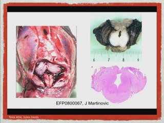 ANOMALIES DU TUBE NEURAL Encéphalocele, exencéphalie et autres anomalies hautes du tube neural.