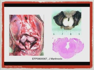 ANOMALIES DU TUBE NEURAL Encéphalocele, exencéphalie et autres anomalies hautes du tube neural.