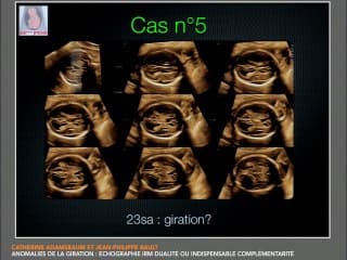 Anomalies de la giration : Echographie IRM dualité ou indispensable complémentarité :