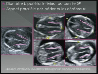 échographie  de la fosse post au 1 er trim