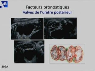 Intérêt de l’échographie foetale dans l’évaluation de la fonction rénale.